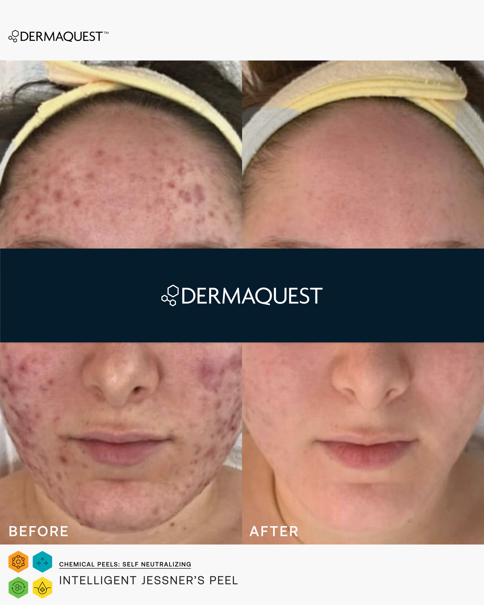 intelligent jessners peel before and after