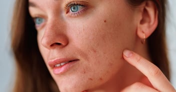 Close up of woman analyzing facial skin and acne