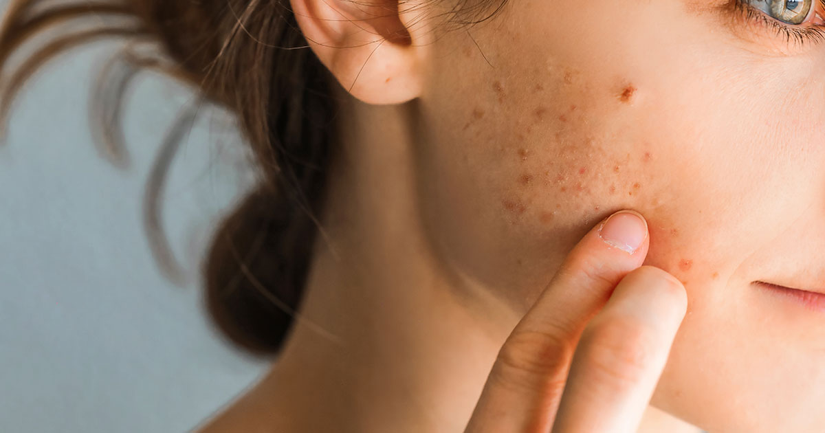 woman holding finger up to acne scars on cheek